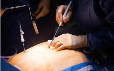 Comprendre le ByPass gastrique en Y