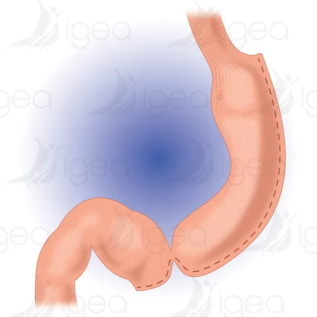 sleeve gastrectomie complications stenose