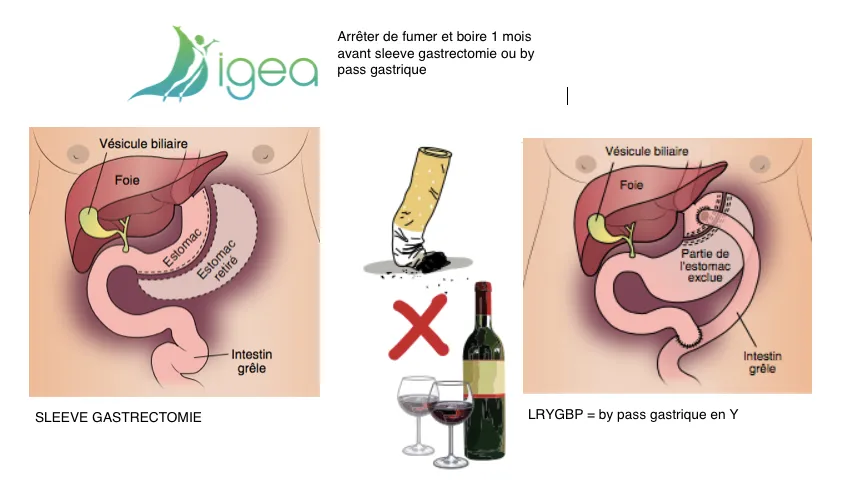 réduire les risques de la chirurgie bariatrique