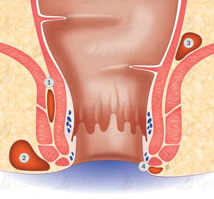 abcès anale schema centre Igea chirurgie proctologique
