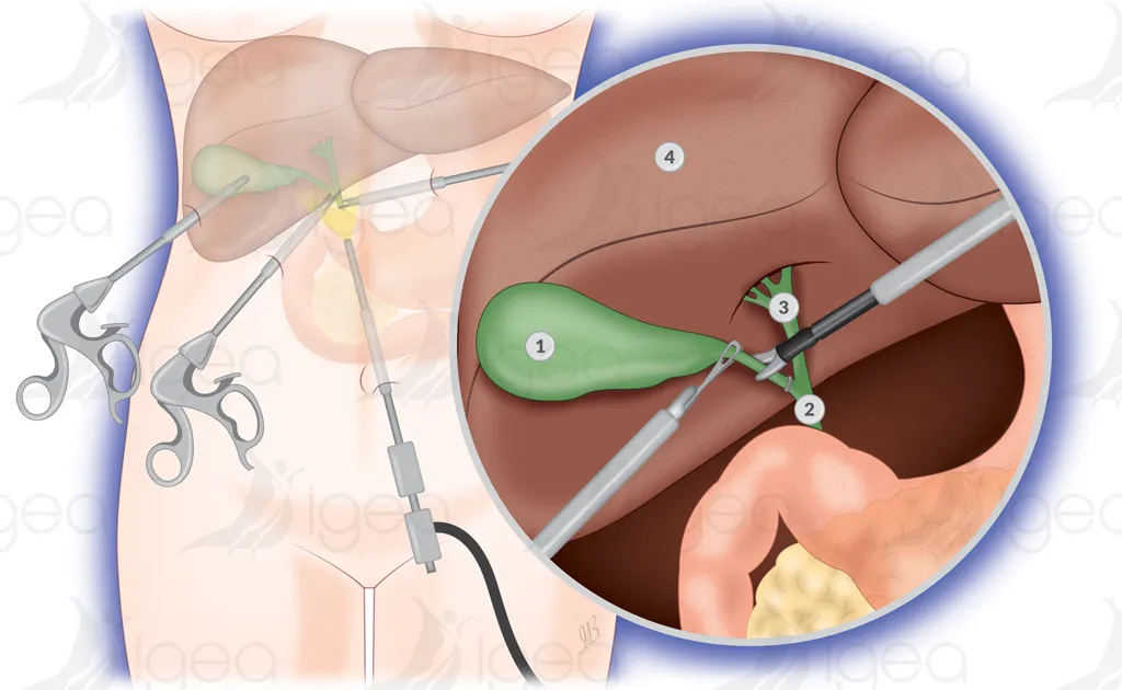 ablation de la vésicule biliaire