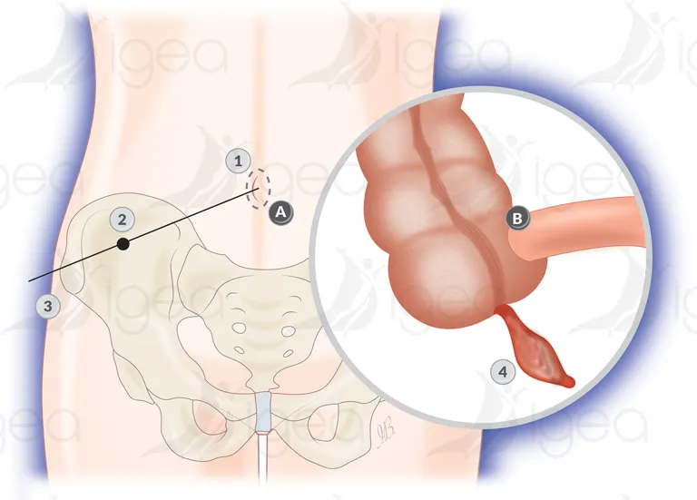 appendicectomie centre de chirurgie digestive, à Montpellier Igea