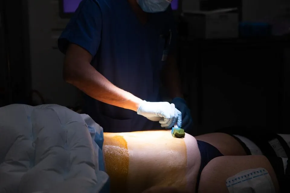 Dermolipectomie abdominale chirurgie digestive Montpellier