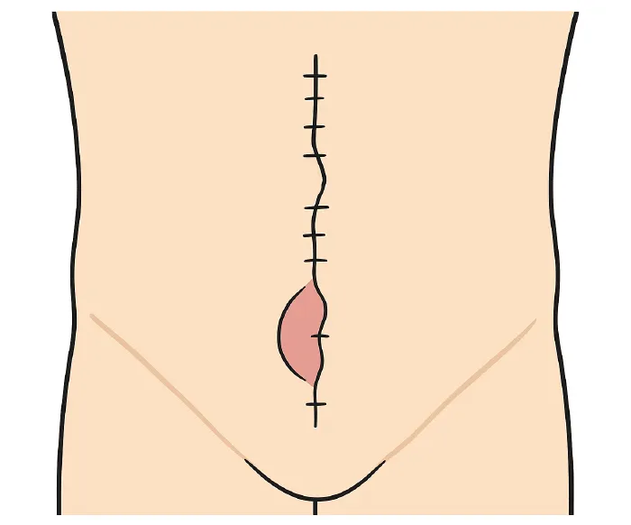 éventration Igea Centre de chirurgie viscérale Montpellier