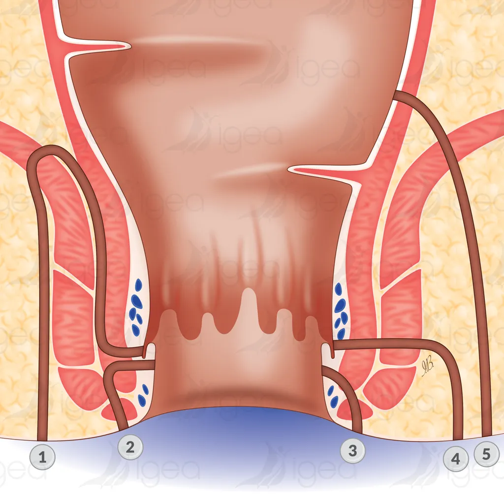fistule anale schema igea