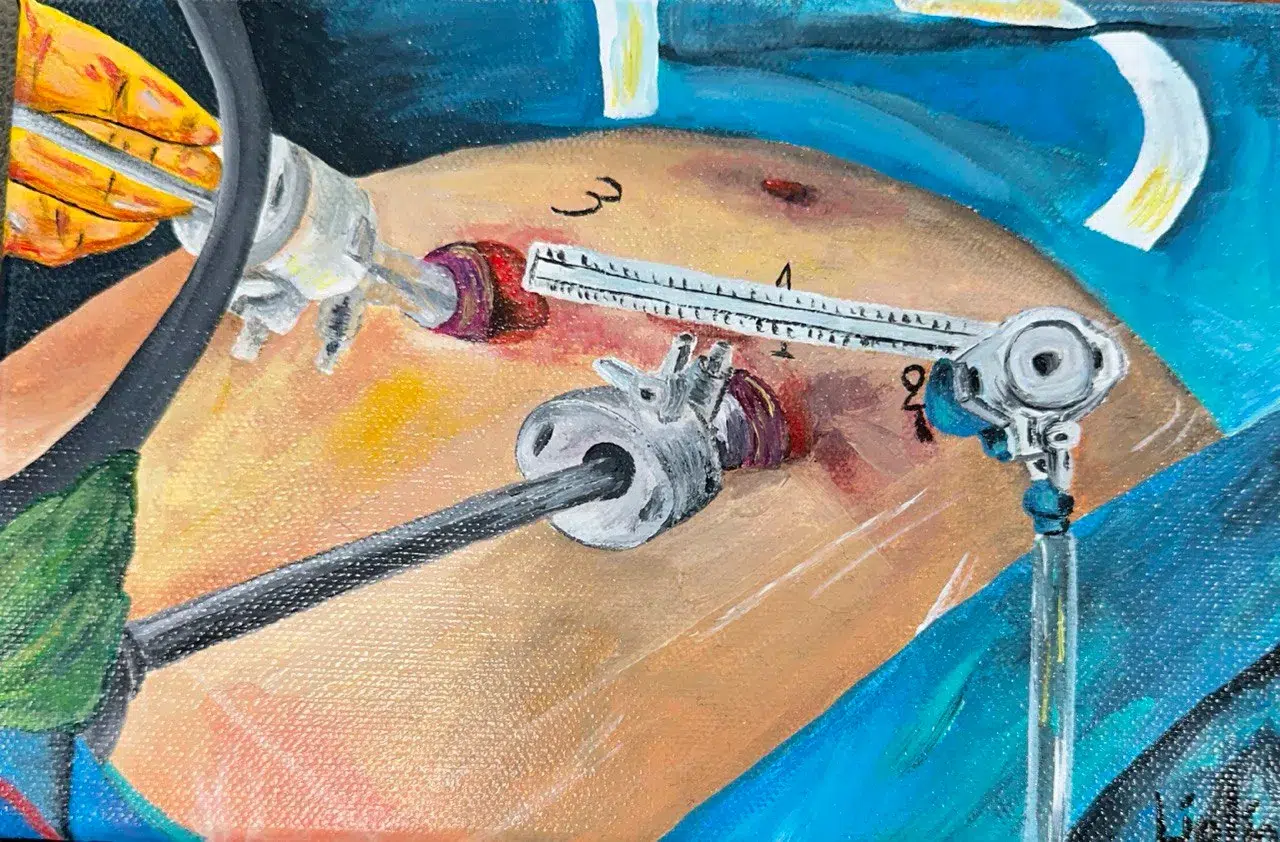 laparoscopie pour une splénectomie