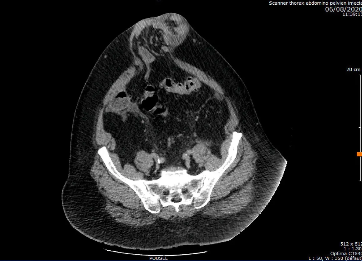 scannographique d’une éventration pour une intervention de cure d'éventration