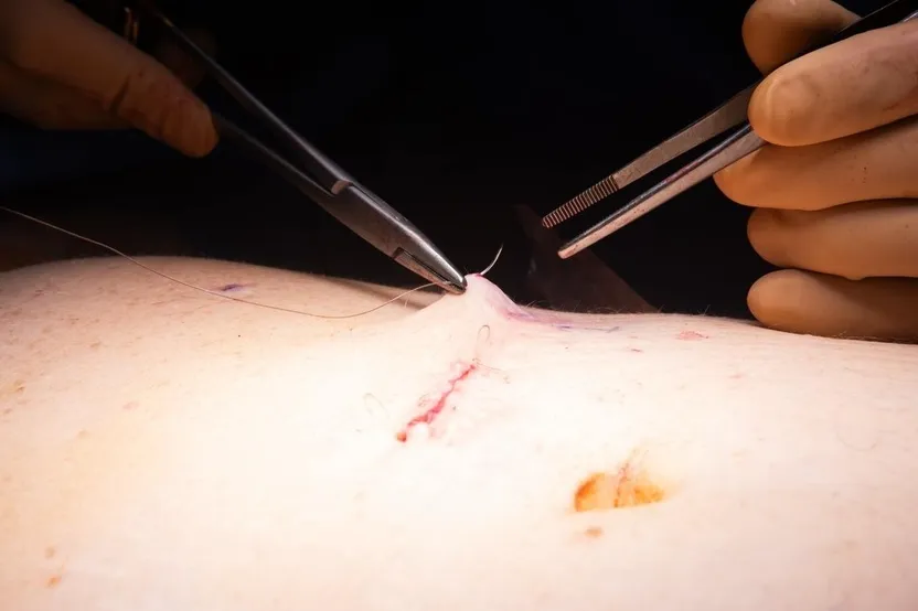 suture cure hernie ombilicale