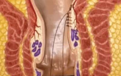 Interview du Dr Vincenzo SALSANO – Expérience française de la technique THD-M présentée au Congrès international de Coloproctologie de Salerne