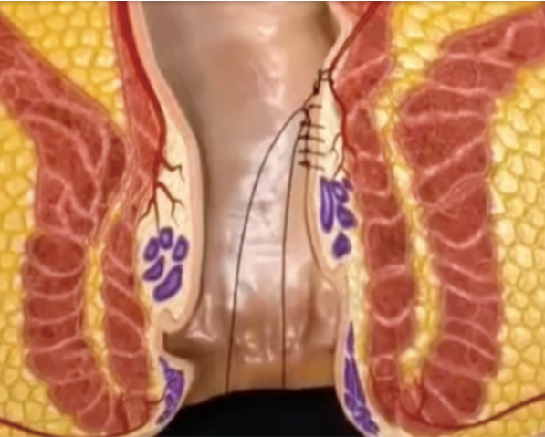 Interview du Dr Vincenzo SALSANO – Expérience française de la technique THD-M présentée au Congrès international de Coloproctologie de Salerne