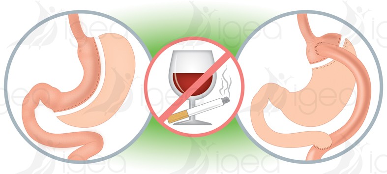 Alcoolisme après bypass