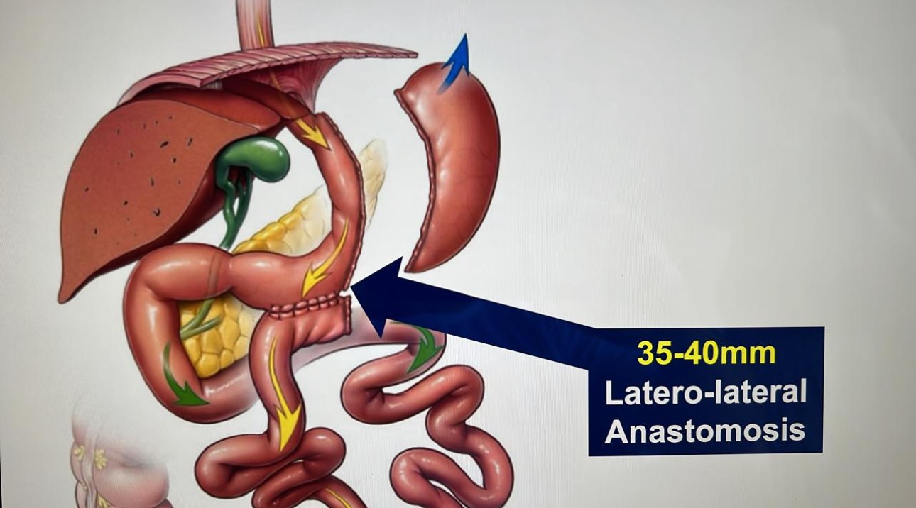 Sleeve gastrectomie avec bipartition du transit anastomose gastro-ileale