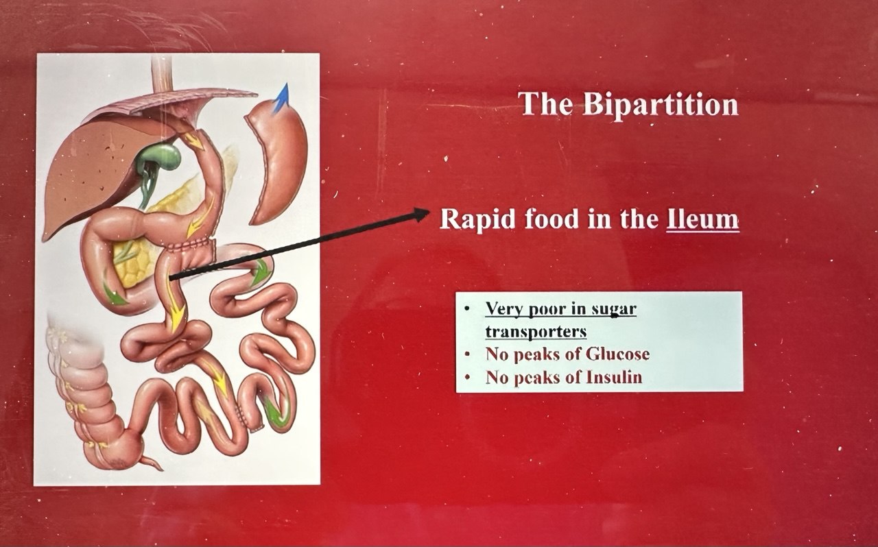 Sleeve gastrectomie avec bipartition du transit