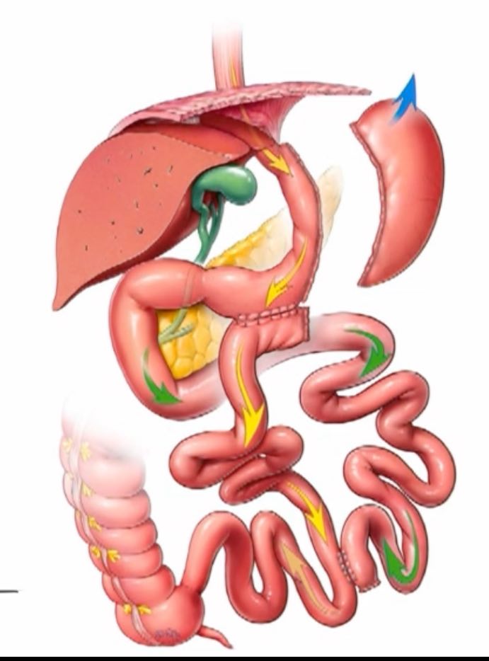 Sleeve gastrectomie avec bipartition du transit, anastomose SG-RY-TB
