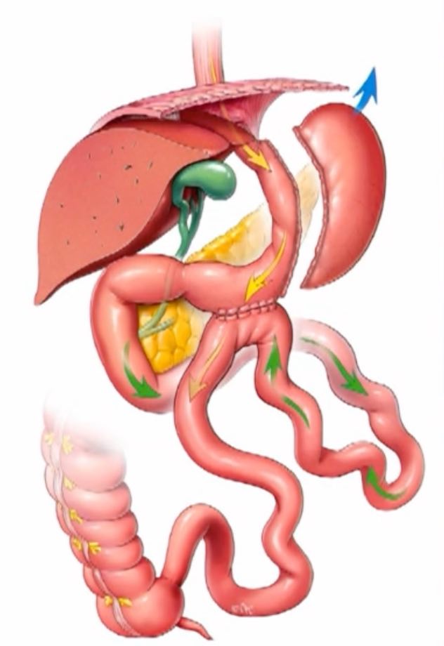 Sleeve gastrectomie avec bipartition du transit, anastomose OATB - SASI